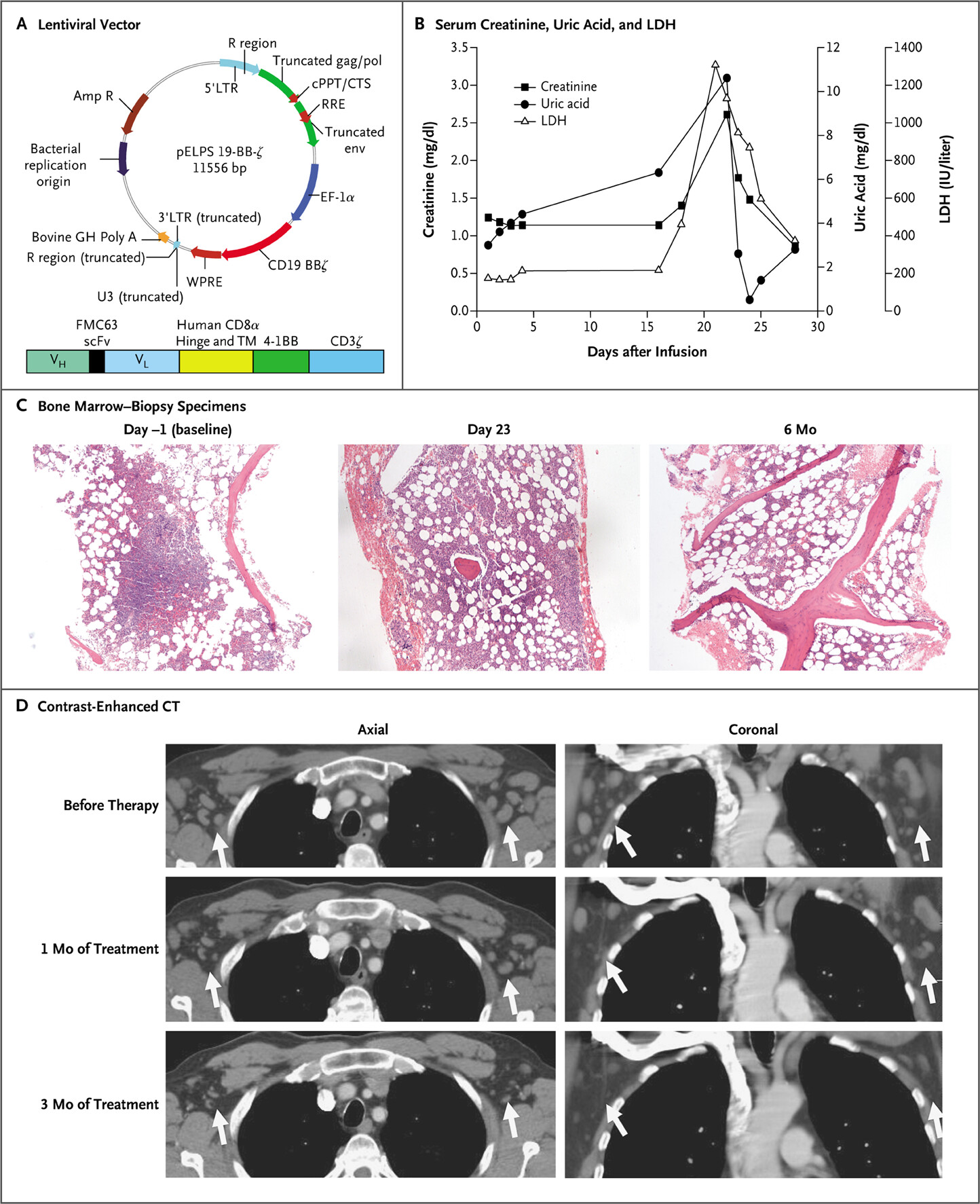 Panel A illustrates the lentiviral vector used to modify T cells for CART19 therapy, containing key functional elements for targeting CD19, while Panels B, C, and D show clinical data and imaging, including serum markers, bone marrow biopsies, and CT scans before and after treatment, highlighting tumor response and recovery.